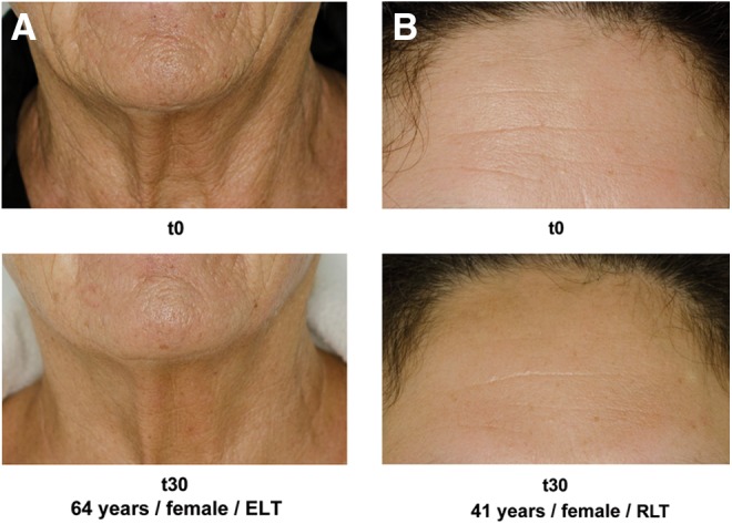 Vorher/Nachher Vergleich von Falten im Gesicht nach Anwendung einer Rotlichttherapie